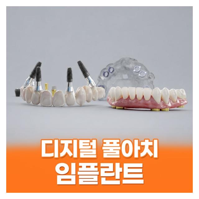디지털 풀아치 임플란트 최소식립 무치악 치료방법